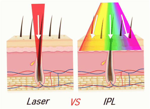 laser och fotopilering är skillnaden